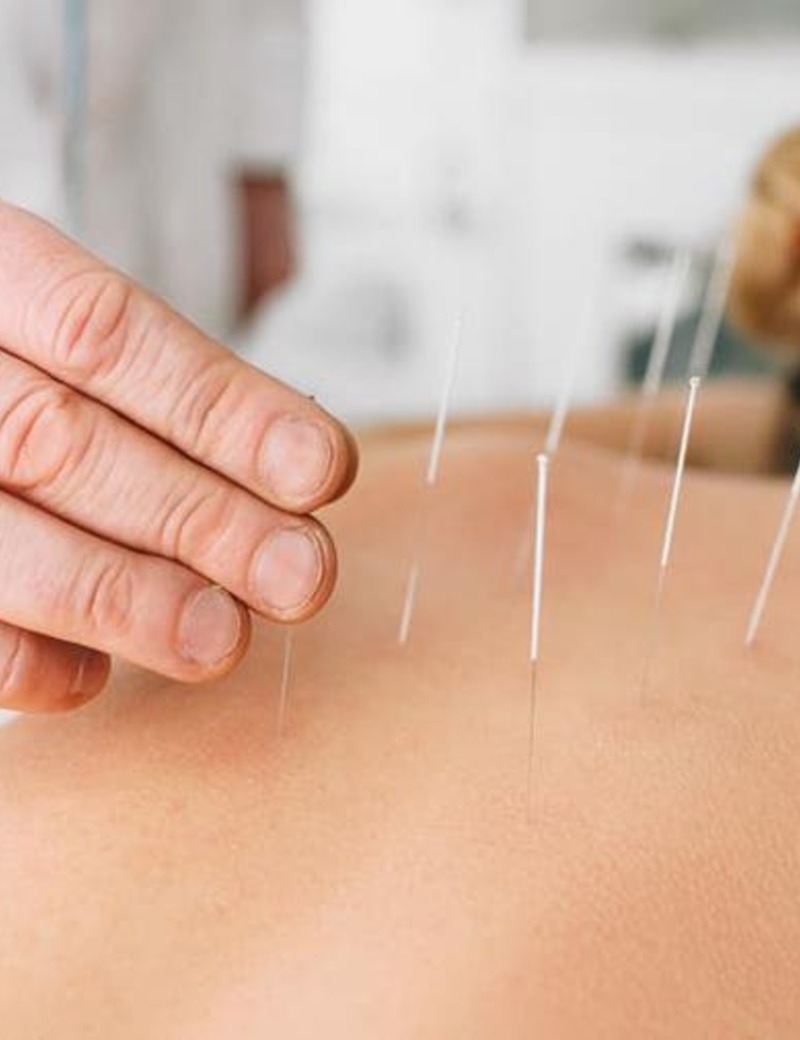 Acupuncture with localized Infrared Red Therapy